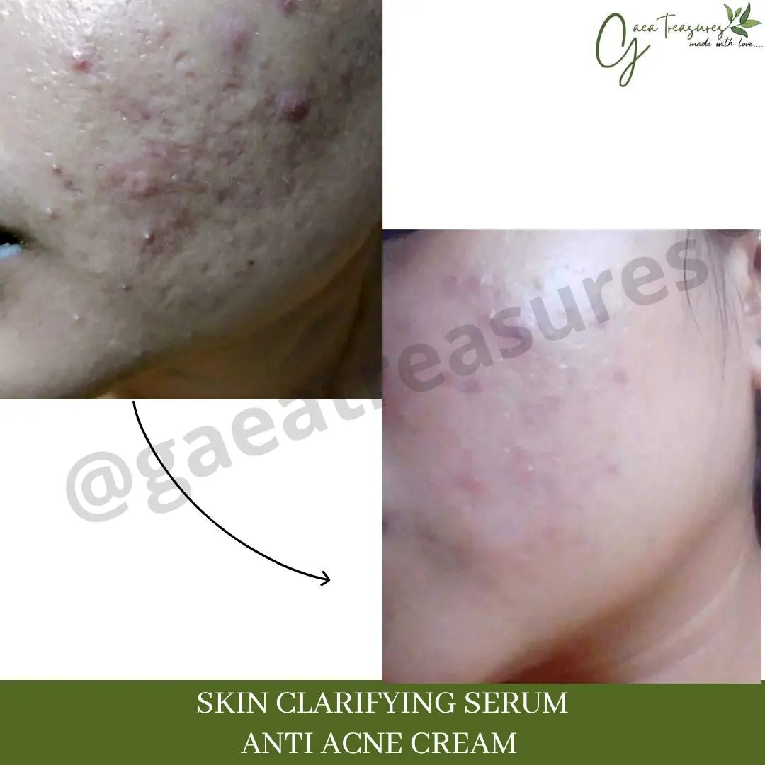 Skin Clarifying Serum - ACNE Treatment