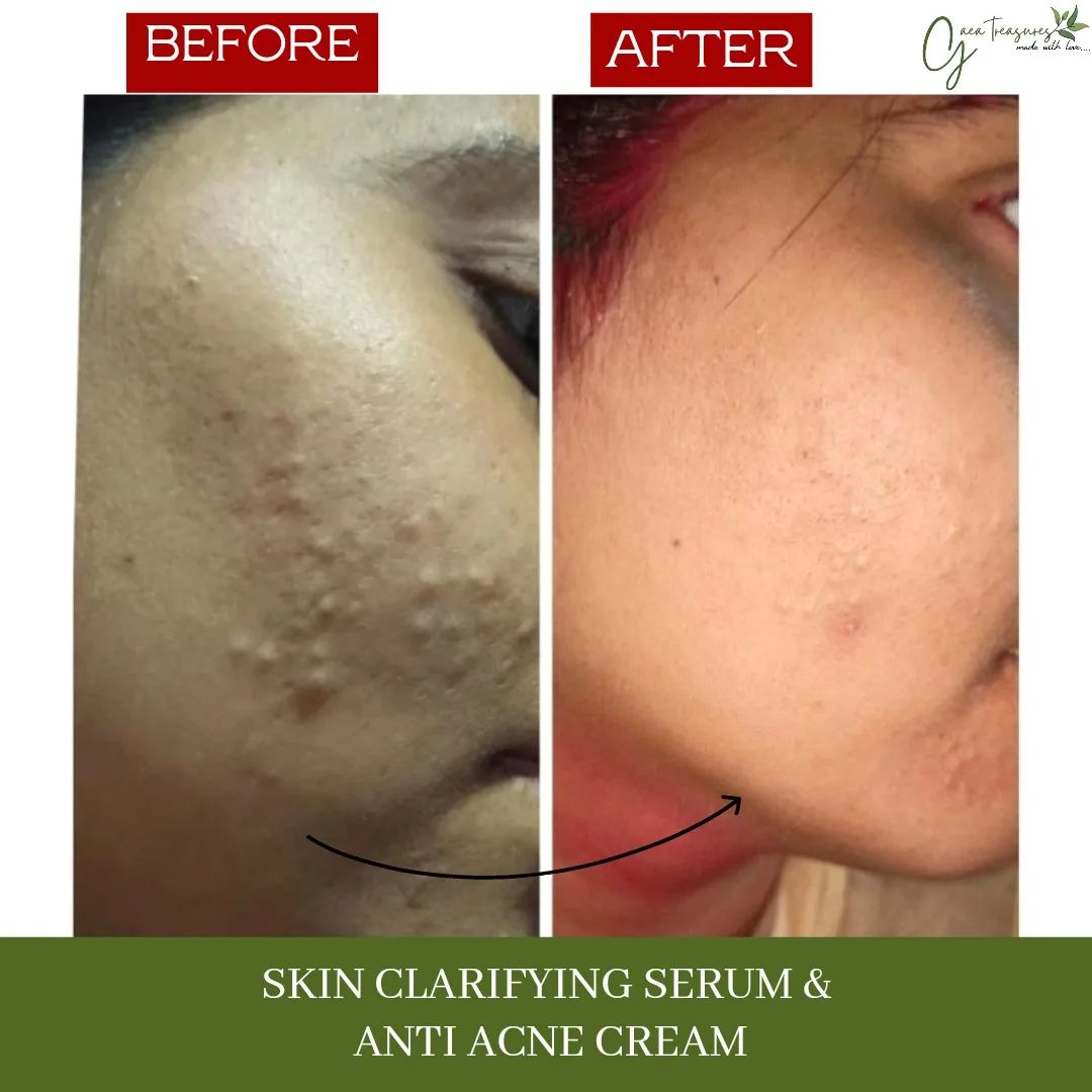 Skin Clarifying Serum - ACNE Treatment