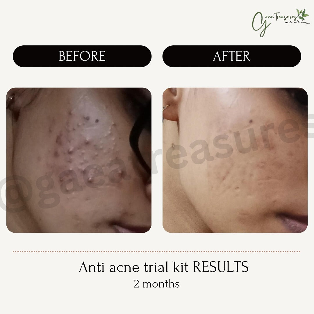 ANTI ACNE Trial Kit